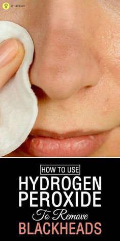 Get Rid Of Stubborn Blackheads With These Natural Remedies Get Rid Of Stubborn Blackheads With These Natural Remedies