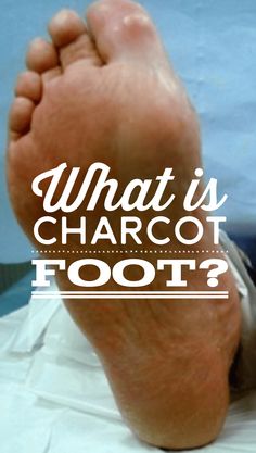 Charcot Foot Natural Treatment Charcot Foot Natural Treatment