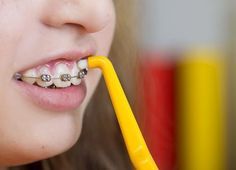 Las 12 Mejores Imagenes De Brackets De Fio Colores Brackets