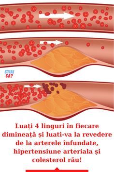 Varice și hipertensiune arterială