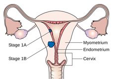 endometrial cancer lawsuit