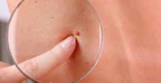Voici Comment Enlever Les Grains De Beauté Naturellement Grains De Beauté Grain De Beauté Visage Santé Naturelle