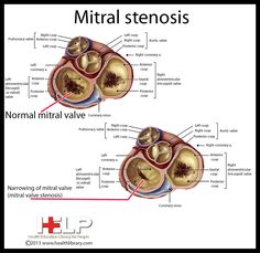 mitral stenosis