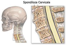 asa m am vindecat de spondiloza cervicala există durere în luxația articulației șoldului
