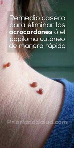 porque me salen lunares rojos en el cuello porque me salen lunares rojos en el cuello