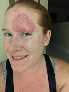 All became treatments for facial skin cancer matchless Pity, that treatments for facial skin cancer have removed