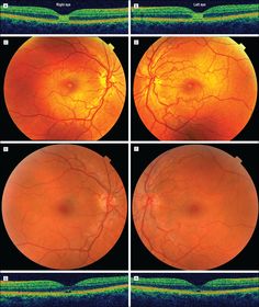 OCT Appearances In Acute Solar Retinopathy OCT Appearances In Acute Solar Retinopathy