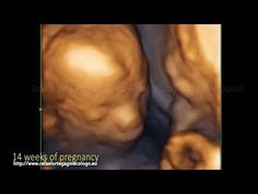 550 Ideas De Diagnóstico Prenatal Diagnóstico Prenatal Prenatal 12 Semanas