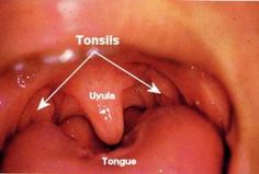 92 best tonsils images tonsillectomy recovery day by day surgery