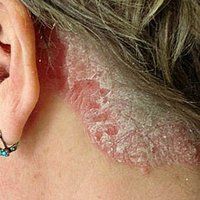 psoriasis disparu