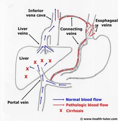 varicose veins in esophagus varicose veins in esophagus