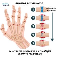 chimiști tratament articular