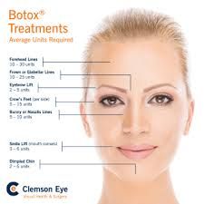 botox injection sites