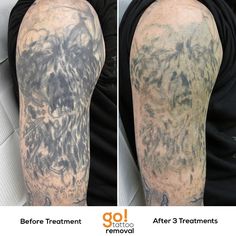 2017 new mole removal dark spot remover pen skin wart tag tattoo 2017 new mole removal dark spot remover pen skin wart tag tattoo