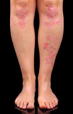 psoriasis and crohn's