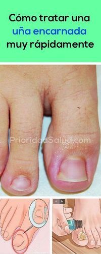 como sacar una uña encarnada en el dedo gordo del pie