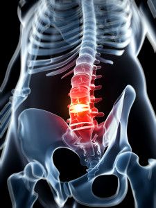 85 Ideas De Hernia Discal Y Otros Problemas De Espalda Hernia Discal Hernia Dolor De Espalda