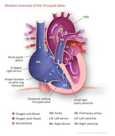 Pin by Ibz on Medicine AKA love | Ebsteins anomaly, Congenital heart