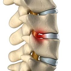 8 Ideas De Ernia Lumbar Hernia De Disco Lumbar Dolor De Espalda Hernias De Disco