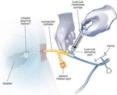 urinary catheterization