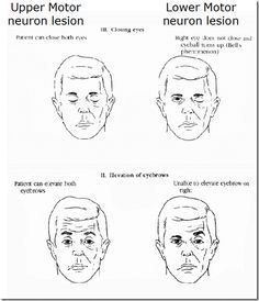 upper motor neuron lesion