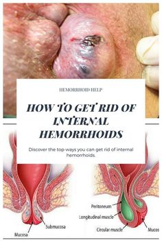 picture External Hemorrhoids Actual Photo pinterest
