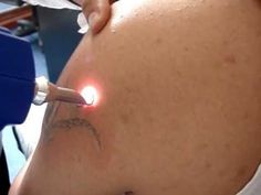 Eliminar Tatuajes Precio Youtube Eliminar Tatuajes Alicante Precio Clínica