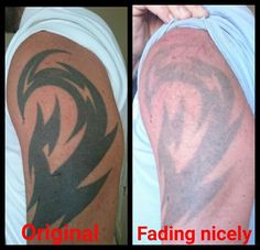 tattoo removal tattoo removal with one treatment with the piqo4 tattoo removal tattoo removal with one treatment with the piqo4