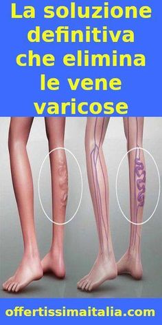 cum de a vindeca vene varicoase fara recenzii de chirurgie