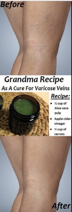 Get Rid of Varicose Veins with Apple Cider Vinegar
