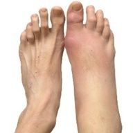 13 best foot arthritis remedies images arthritis remedies home