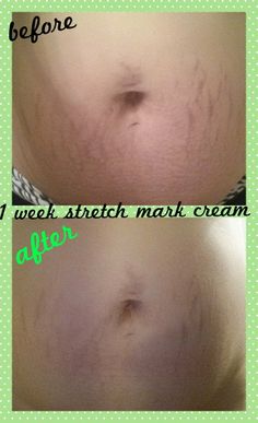 stretch marks she got these results by using it works stretch mark stretch works
