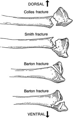 colles fracture smith fracture colles fracture smith fracture