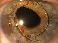 Best brown cataract eye in mature mumbai operation sub surgeon Amateur big tit streaming tubes