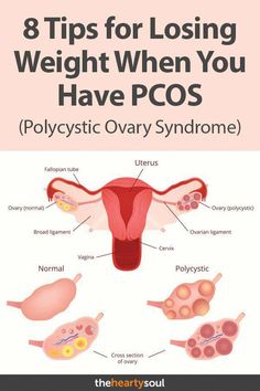 micción frecuente mientras toma metformina para pcos micción frecuente mientras toma metformina para pcos