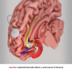 Deep brain penetration for depression Nylon overall fetish