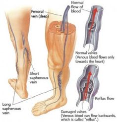 osteopat cu recenzii varicose vene