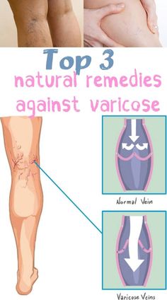 gimnastica de la picior varicose puncte pe corp de la varicoza