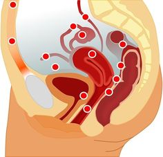 cum să tratați endometrioza dacă există varicoză varicoze picături recenzii