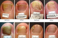 9 Best How to get rid of toenail fungus images | Toe nails