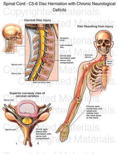 14 best anterior cervical discectomy and fusion images acdf