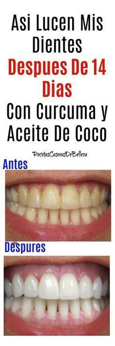 Endodoncia antes y despues de adelgazar