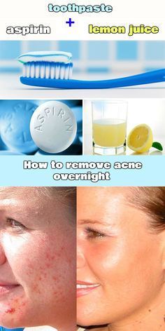 LaS negrAS Acne infant treatment acne scarring facial cleanser was him