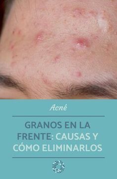 25 Ideas De Acné En 2021 Mascarillas Para Acne Eliminar Acné Como Quitar Granos