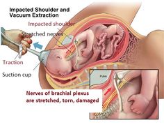28 best erbs palsy images plexus products erb palsy birth erb duchenne
