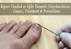 Onychoschizia Natural Treatment Onychoschizia Natural Treatment
