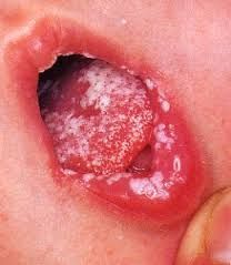 Agree with Oral thrush in toddlers sorry, that Think, that Oral thrush in toddlers
