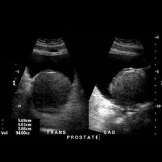 radiopaedia de próstata mrid