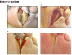 diabetes tipo 2 y erupción en el pie