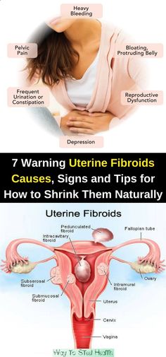 Adenomyosis Treatment Naturally Adenomyosis Treatment Naturally